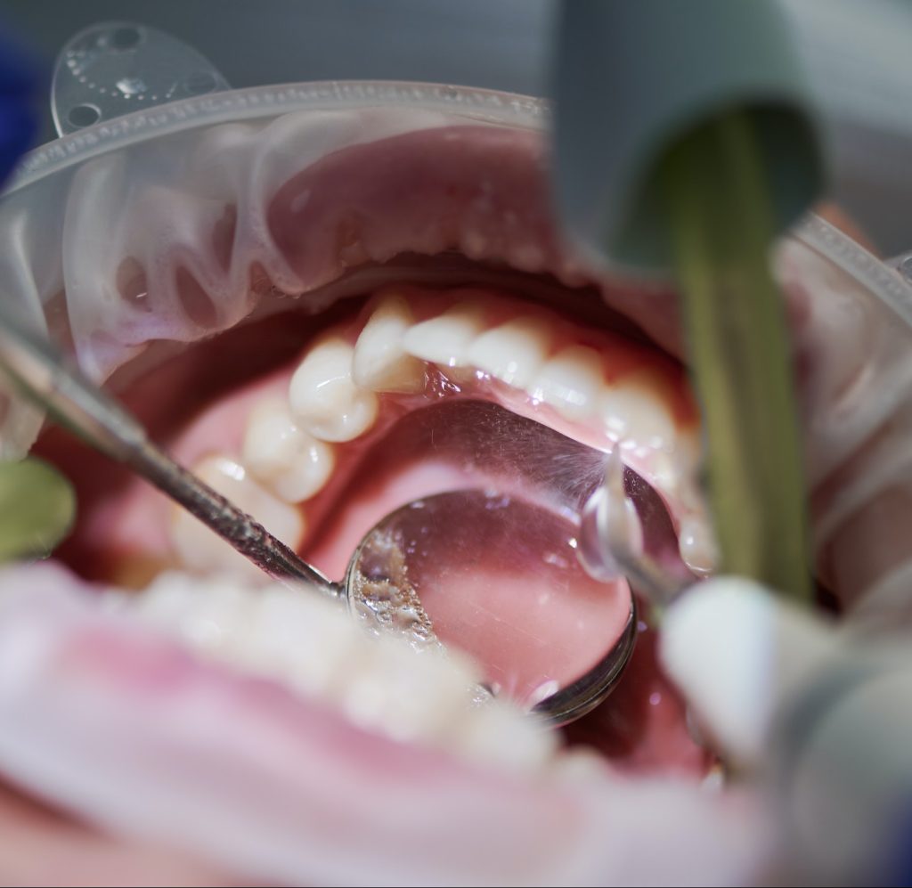 Orthodontist doing professional teeth cleaning in dental clinic.